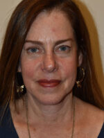Facelift and Necklift