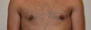 Gynecomastia