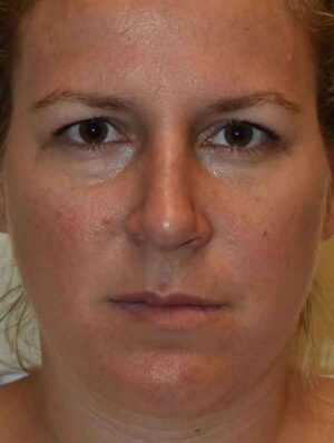 Nose Surgery
