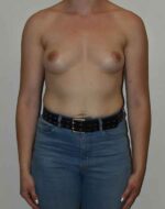 Breast Augmentation