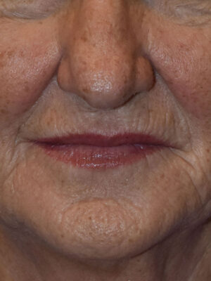 Laser, Chemical Peels & Dermabrasion Case 46687 Before Photo Laser, Chemical Peels & Dermabrasion