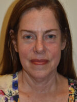 Facelift and Necklift
