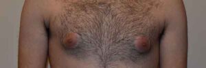 Gynecomastia