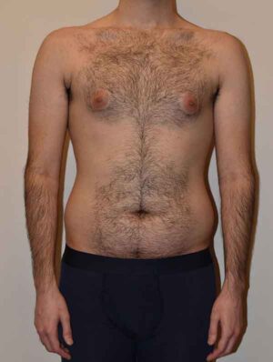 Liposuction Case 46235 Before Photo Liposuction
