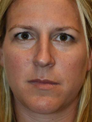 Nose Surgery