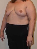 Breast Reduction