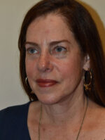 Facelift and Necklift