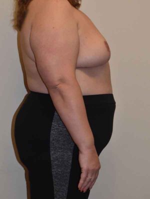 Breast Reduction Case 46262 After Photo Breast Reduction