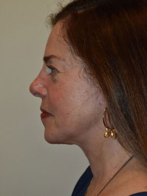 Facelift and Necklift Case 46677 After Photo Facelift and Necklift