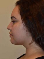 Neck Liposuction