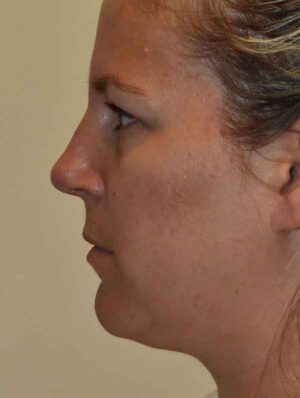 Nose Surgery