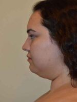 Neck Liposuction