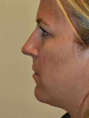 Nose Surgery