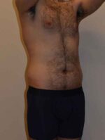Liposuction