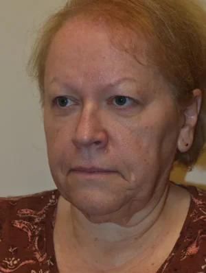 Facelift and Necklift