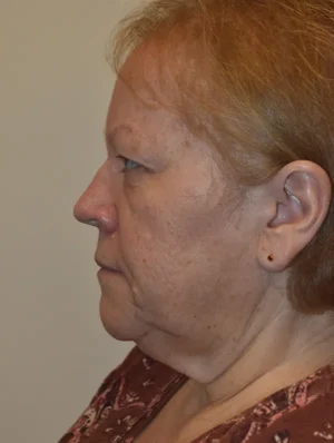 Facelift and Necklift