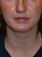 Chin Implants