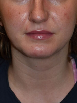 Chin Implants