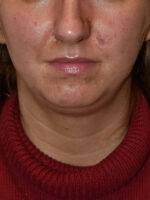 Chin Implants