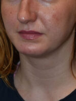 Chin Implants