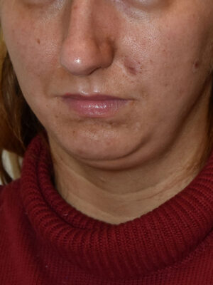 Chin Implants