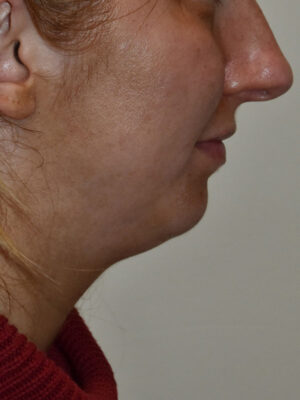 Chin Implants