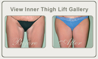 thigh lift thumb