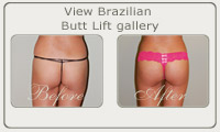 brazillian butt lift Before & After Photo San Diego