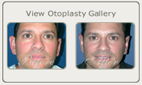 otoplasty thumb