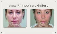 rhinoplasty thumb