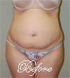 Tummy Tuck