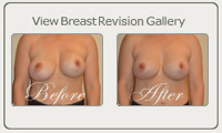 Breast-revision-Thumb