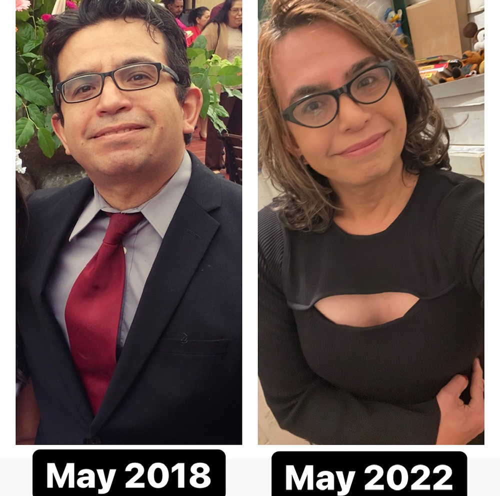facial-feminization